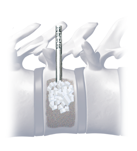 ハイドロキアシアパタイト製骨補填材　充填イメージ